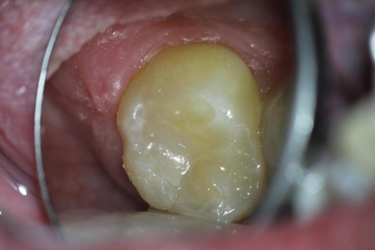 Filling-Cavities-After-Image