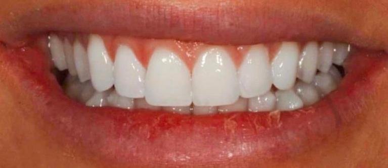 Glo-Whitening-After-Image