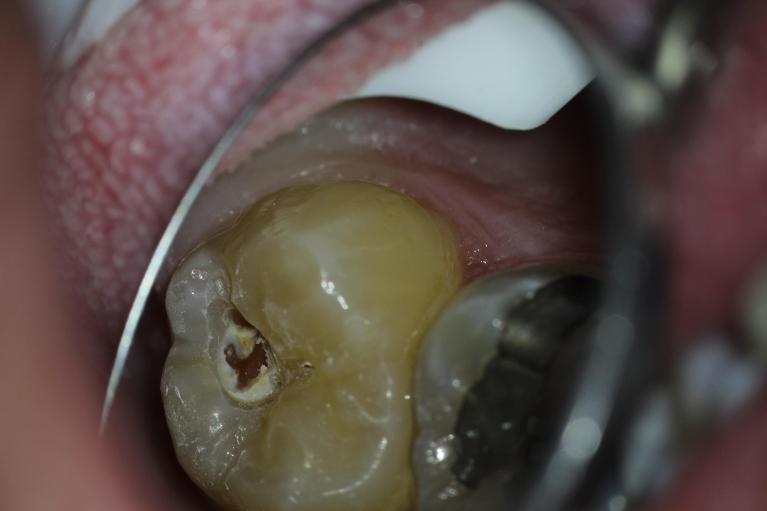 Filling-Cavities-Before-Image