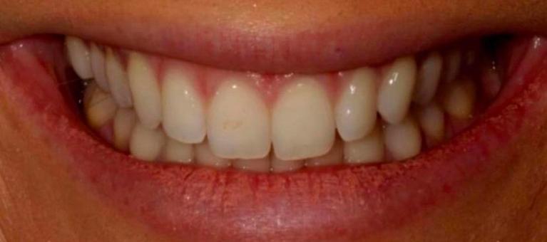 Glo-Whitening-Before-Image