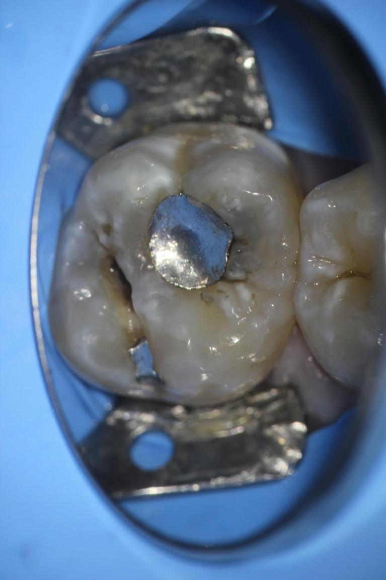 Metal-Filling-to-Tooth-Colored-Before-Image